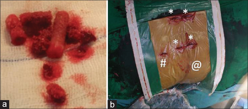 (a) Percutaneously extracted bone graft from iliac crest. (b) Body incisions and access ports: incision 2 cm each for the percutaneous screws [*] 1.5 cm incision for bone graft extraction [#] and 7 mm incision [@] of endoscope access